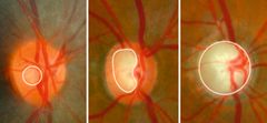 Vid glaukom kan det uppstå en förlust av nervtrådar (kablar från näthinnan till hjärnan). Till vänster: Bild på ett öga utan glaukom. Avståndet är stort mellan inre begränsningen av nervtrådar (markerat med vit ring) och synnervshuvudets yttre begränsning. I mitten: Pågående sjukdom där nervfibrer har försvunnit så att avståndet mellan den vita ringen och periferin har reducerats. Höger: Slutstadium glaukom. Nästan alla nervfibrer har försvunnit så att avståndet mellan den vita ringen och synnervshuvudets yttre begränsning nästan är utraderat.
