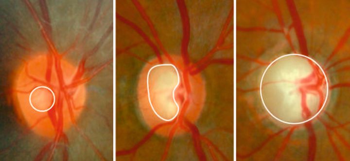 Vid glaukom kan det uppstå en förlust av nervtrådar (kablar från näthinnan till hjärnan). Till vänster: Bild på ett öga utan glaukom. Avståndet är stort mellan inre begränsningen av nervtrådar (markerat med vit ring) och synnervshuvudets yttre begränsning. I mitten: Pågående sjukdom där nervfibrer har försvunnit så att avståndet mellan den vita ringen och periferin har reducerats. Höger: Slutstadium glaukom. Nästan alla nervfibrer har försvunnit så att avståndet mellan den vita ringen och synnervshuvudets yttre begränsning nästan är utraderat.