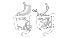 Fler individer med BMI över 50 bör erbjudas operation med metoden duodenal switch anser forskare i Uppsala. På bilden syns till vänster magtarmkanalens normala anatomi, till höger utseendet efter en sådan operation.