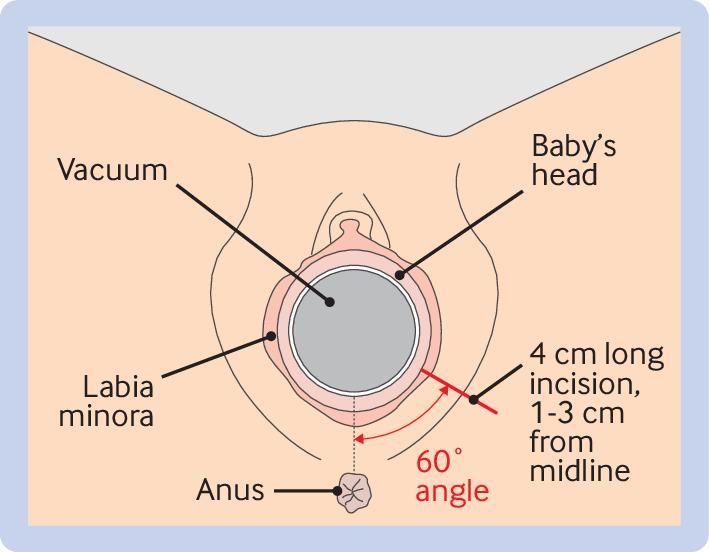 Lateral episiotomy