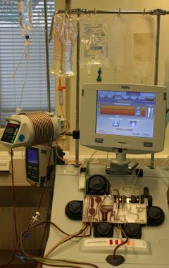 Aferesmaskin för skörd av blodstamceller inför transplantation