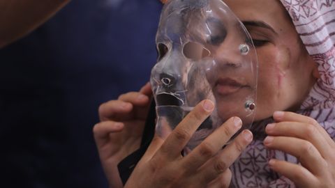 En av Läkare Utan Gränsers patienter i Gaza testar en kompressionsmask som tagits fram genom en 3D-skrivare. Foto: Lyad Alasttal.