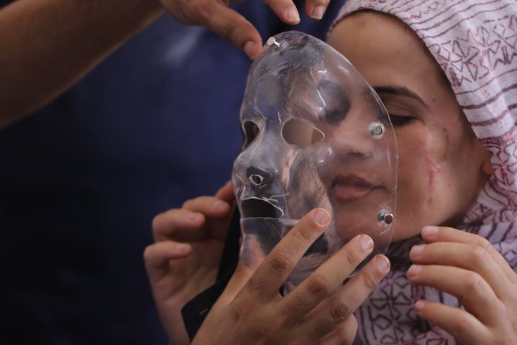 En av Läkare Utan Gränsers patienter i Gaza testar en kompressionsmask som tagits fram genom en 3D-skrivare. Foto: Lyad Alasttal.