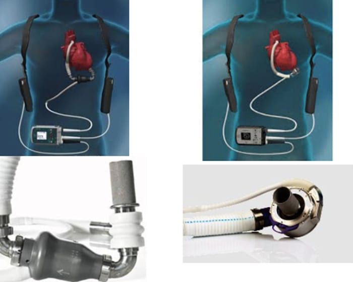 På Akademiska sjukhuset används två typer av batteridrivna hjärtpumpar, så kallade Left Ventricular Assist Devices (LVADs). Den senaste generationens pump (höger) är så liten att den ryms i hjärtsäcken.