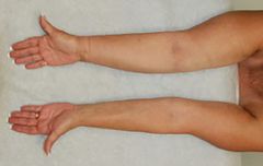 Lymfödem innebär att lymfvätska ansamlas i vävnaden på grund av ett skadat lymfsystem, exempelvis efter bröstcancerbehandling (höger arm på bilden).