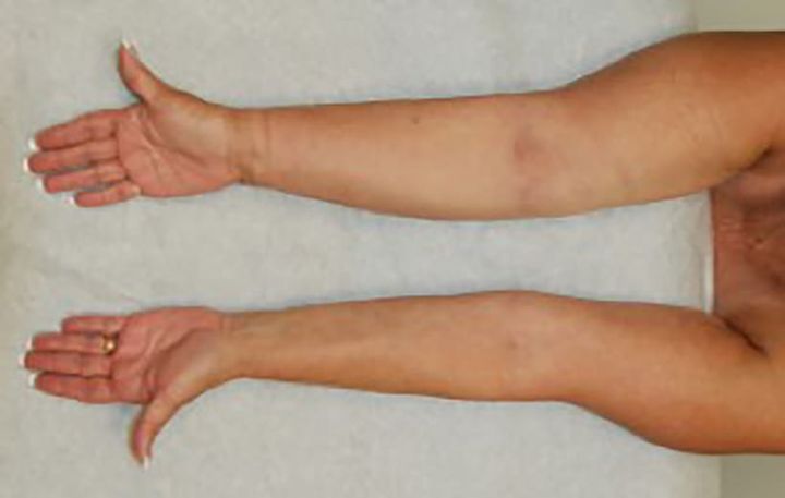 Lymfödem innebär att lymfvätska ansamlas i vävnaden på grund av ett skadat lymfsystem, exempelvis efter bröstcancerbehandling (höger arm på bilden).