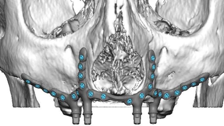 Förra året introducerade Akademiska sjukhuset en ny metod för återställande av tänder för personer som saknar käkben, där vanliga tandimplantat inte fungerar. Röntgenbilden visar hur man skruvar på en bro på pelarna nedåt direkt under operationen.