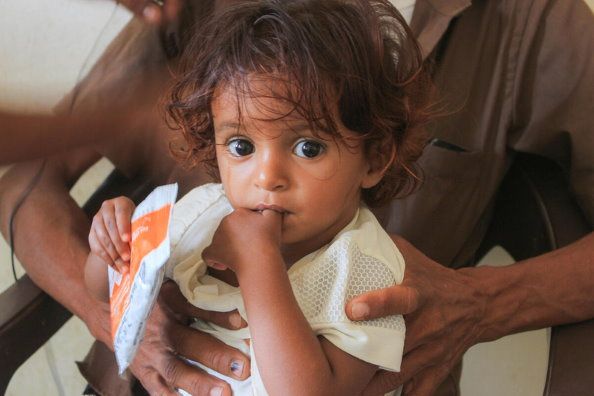 Ett barn får näringsriktigt stöd från WFP på en klinik i Hajji City i Jemen Foto: Issa Al-Raghi, WFP