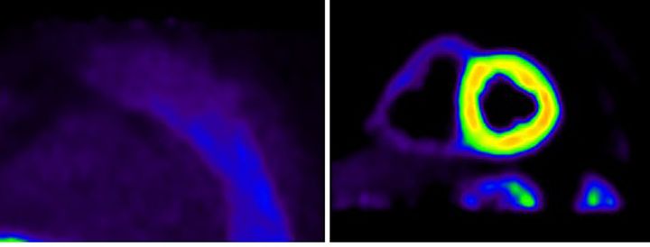 PET-bilden visar skillnaden mellan ett friskt hjärta (vänster) och ett hjärta med amyloidosaggregat/inlagring (höger). Foto: Akademiska sjukhuset