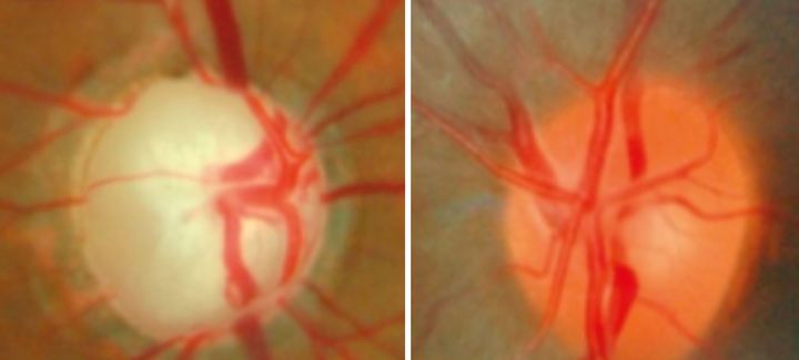 Till vänster: Höger synnerv i öga hos patient med glaukom. Till höger: Vänster synnerv i normalt öga. Den gulbleka färgen i höger öga beror på att nerver som överför information från ögat till hjärnan saknas. Foto: Akademiska sjukhuset