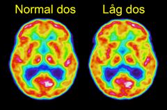 PET-avbildning av en frisk försöksperson med normal respektive hög dos.