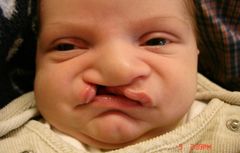 Barn som föds med läpp-käk-gomspalt löper ökad risk för språkstörning, autismspektrumstörning, ADHD, psykotiska sjukdomar med flera neuropsykiatriska funktionsnedsättningar. Det visar en registerstudie vid Uppsala universitet/Akademiska sjukhuset.