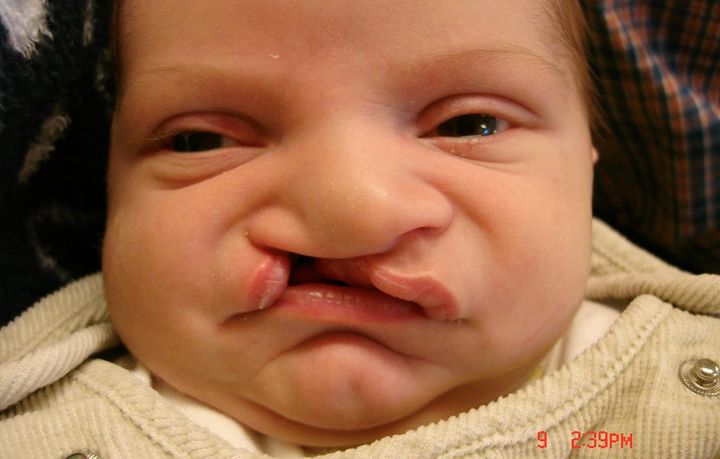 Barn som föds med läpp-käk-gomspalt löper ökad risk för språkstörning, autismspektrumstörning, ADHD, psykotiska sjukdomar med flera neuropsykiatriska funktionsnedsättningar. Det visar en registerstudie vid Uppsala universitet/Akademiska sjukhuset.