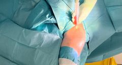 Efter höft- och knäledsoperationer är infektioner kring protesen den vanligaste tidiga komplikationen. om första sjukhus i Sverige har Akademiska börjat behandla svåra protesinfektioner med bakteriofager som skräddarsys utifrån vilka bakterier patienten drabbats av.