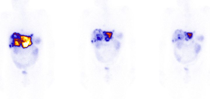 Bilden visar hur utbredningen av levermetastaser minskar under pågående 
radionuklidterapi med Lutetium-177.