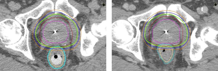 Bilderav prostata med datortomografi, till vänster med rektalstav, till höger utan. Målområdet för strålbehandlingen syns i rött, ändtarmen (rektum) i turkos och ändtarmsväggen i gult. 95, 85 och 76 procent av ordinerad stråldos visas med grön, blå o