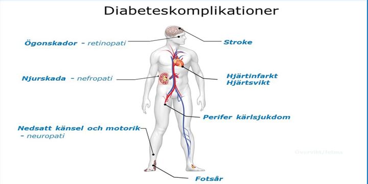 Illustrationen visar olika komplikationer som förekommer vid diabetes.
