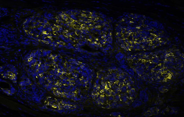 Insulinproducerande celler framodlade ur stamceller, experimentellt transplanterade till en muskel. Insulin ses i gult och cellkärnor i blått.