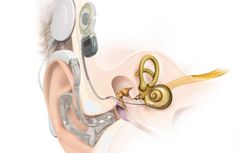 Hörselbevarande impantat (EAS) blir allt vanligare. Nio av tio patienter med svår hörselnedsättning har bevarad hörsel efter operationen.