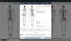 The automated Bone Scan Index (aBSI) technology, developed by EXINI Diagnostics AB