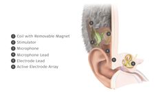 MED-EL Launches World's First Commercially Available Totally Invisible Cochlear Implant