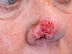 Patient med cancertumör på näsvingen innan behandling.