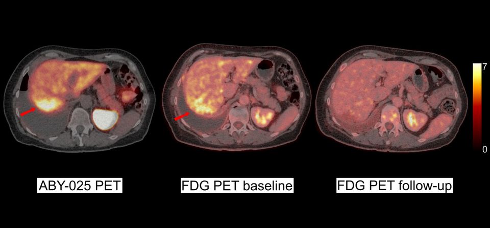 Positron emission tomography (PET) provides faster and more accurate diagnosis of aggressive breast cancer