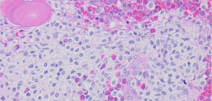 Akademiska sjukhuset har officiellt etablerat ett Centre of Excellence för blodsjukdomen mastocytos där patienter erbjuds sammanhållen utredning/diagnostik, information och behandling. Mastocytos är en blodsjukdom som bland annat manifesteras med mastcellshärdar i benmärgen (de stora ljusa cellerna på bilden).