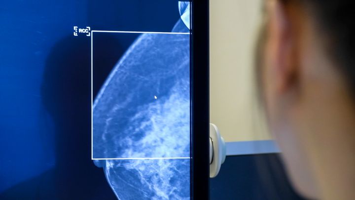 Cancerfonden vill att åldersgränsen för mammografi ses över. Foto: pressbild