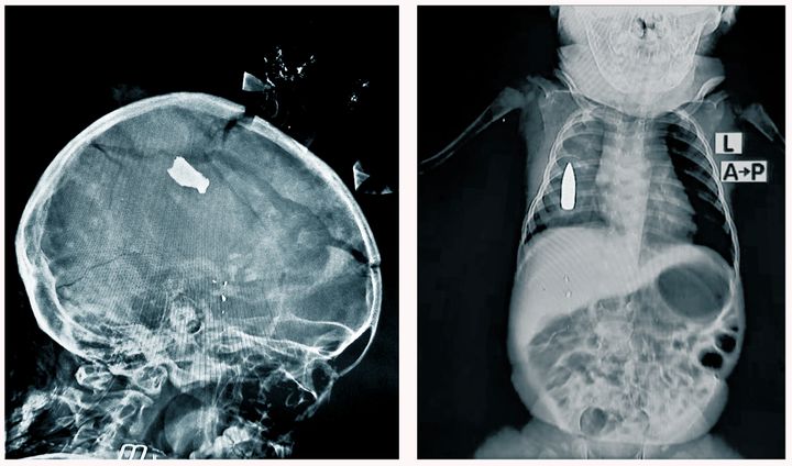 Två röntgenbilder på två barn som har vårats på Bashair Teaching Hospital i Khartoum. Den ena har träffats i skallen av splitter och den andra har en kula i bröstet.