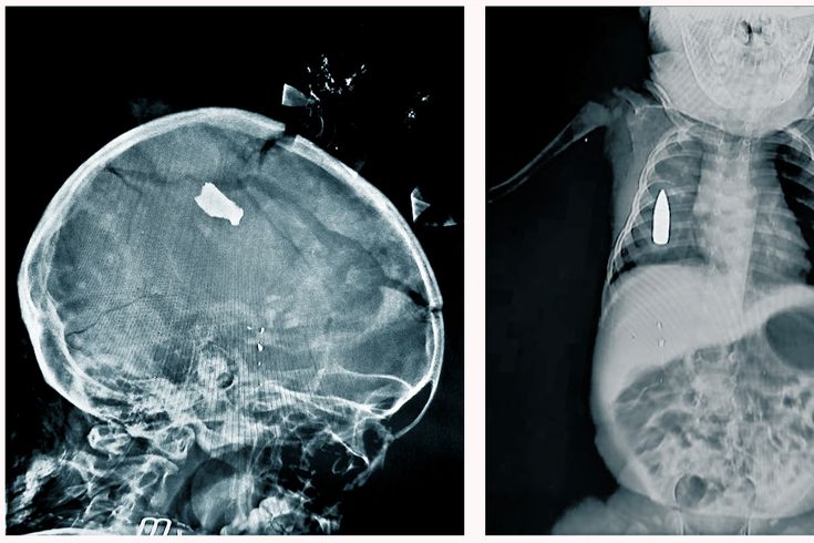 Två röntgenbilder på två barn som har vårats på Bashair Teaching Hospital i Khartoum. Den ena har träffats i skallen av splitter och den andra har en kula i bröstet.