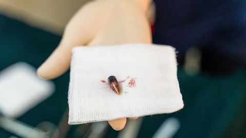 En kula från en skottskadad patient ligger på en kompress som vårdpersonal på Bashair-sjukhuset i södra Khartoum håller fram.