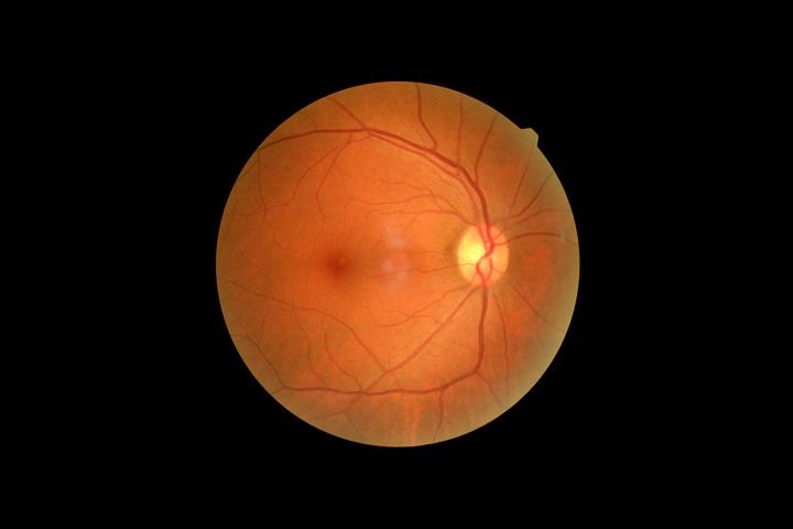 Bilder av näthinnan gör det möjligt att hitta tidiga tecken på Alzheimers sjukdom enligt forskare vid Blekinge Tekniska Högskola.