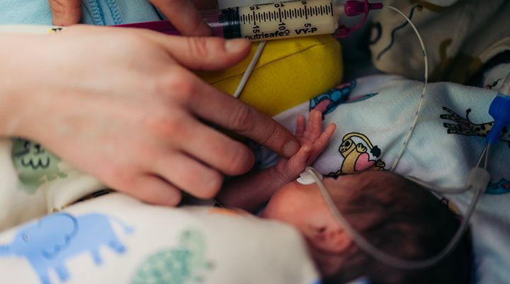 En bebis får mat via sond.