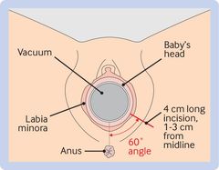 Lateral episiotomy Illustration of a lateral episiotomy in the EVA trial