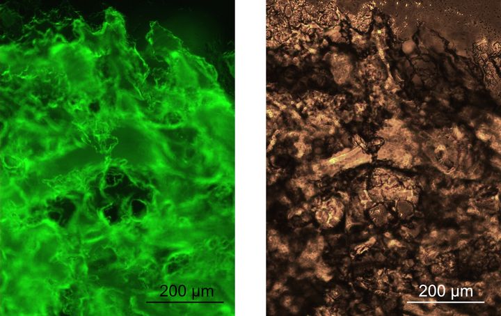 Fluorescent hydrogels The hydrogels stained with a fluorescent dye that binds to amyloid structures and the corresponding brightfield image.