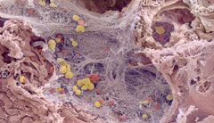 Electron micrograph of a human lung with COVID-19.