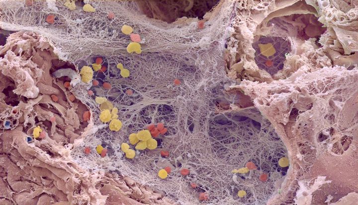 Electron micrograph of a human lung with COVID-19.