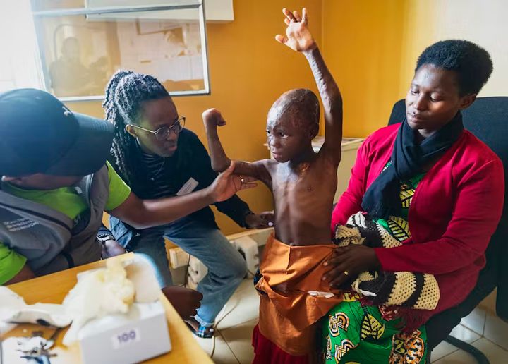 Usanases kropp är svårt brännskadad och hon behöver många operationer för att få ett drägligt liv. Var tredje månad, när Operation Smile genomför utbildningsuppdrag för blivande plastikkirurger i Rwanda, får hon en ny operation. Foto: Jörgen Hildebrandt