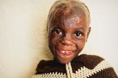 Usanase, 6 år, brännskadades svårt över hela kroppen som baby. Hennes ena öra saknas och håret kommer aldrig växa ut igen. Foto: Jörgen Hildebrandt