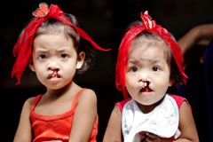 Systrarna Jheleen och Andrea föddes båda med läpp-käk-gomspalt.