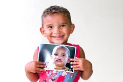 Rogério i Brasilien före och efter sin läppspaltsoperation.