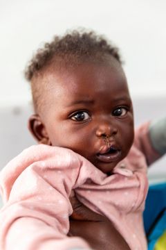 Babypojke med stygn i läppen efter en operation.