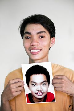 Tonårspojke tittar in i kameran. Han håller ett foto av honom själv som ung. Man ser att han har fått en operation för sin läppspalt; före och efter operationen.