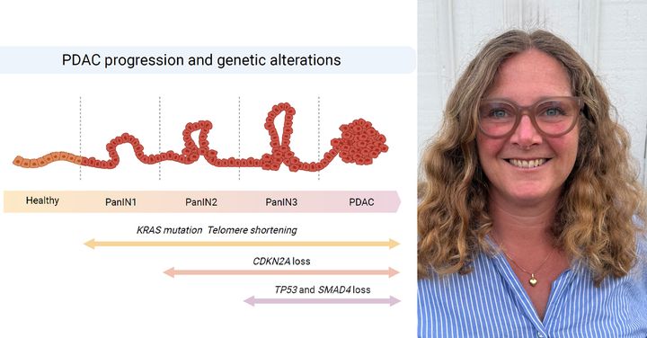 Figur från Eva Philipsons avhandling. Modell som visar hur pankreascancer av typen PDAC, den vanligaste formen av pankreascancer, utvecklas genom olika stadier och genetiska mutationer. Porträtt på Eva Philipson.