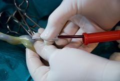 Någon samlar in blod från en navelsträng med en spruta.