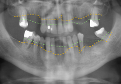 Röntgenbild av tänder med tandlossning och förluster. Streckade gröna linjen: ursprunglig käkbensnivå. Streckade gula linjen: minskat benstöd på grund av inflammation.